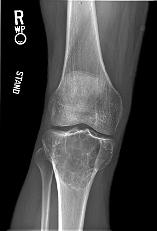 Aneurysmal Bone Cyst Figure 1