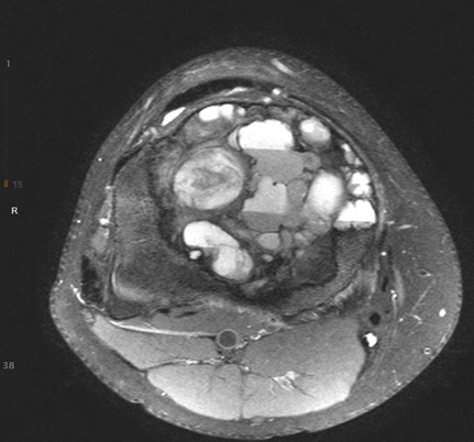 Aneurysmal Bone Cyst Figure 2