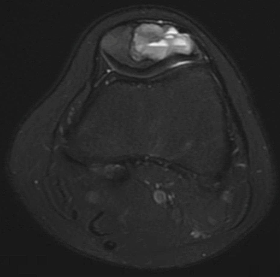 Chondrblastoma Figure 2