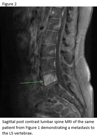 Chondrosarcoma Figure 2