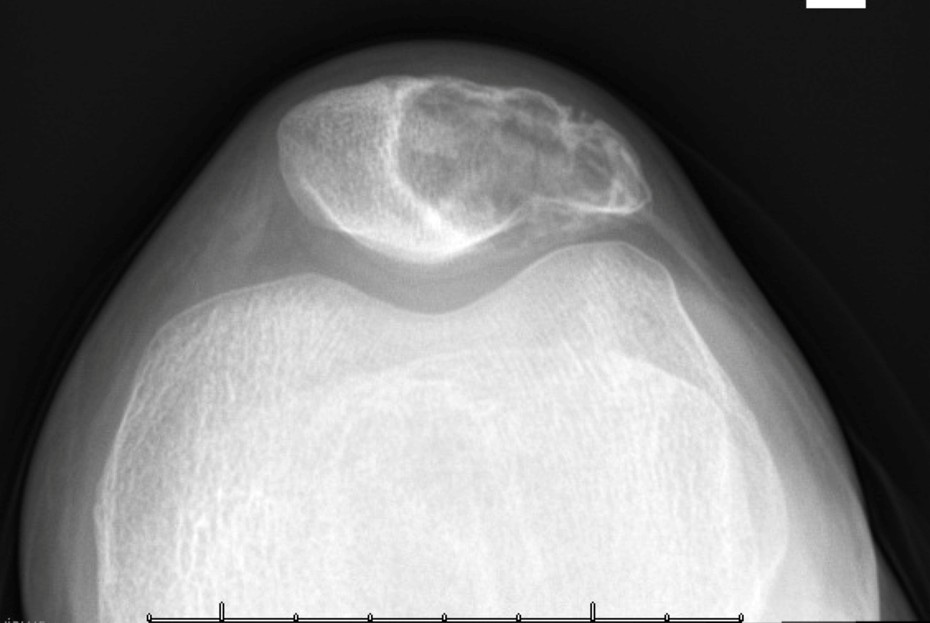 Chondroblastoma Figure 1