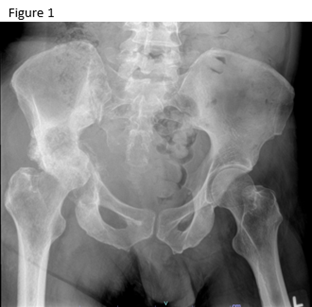 Chondrosarcoma Pelvis x-ray