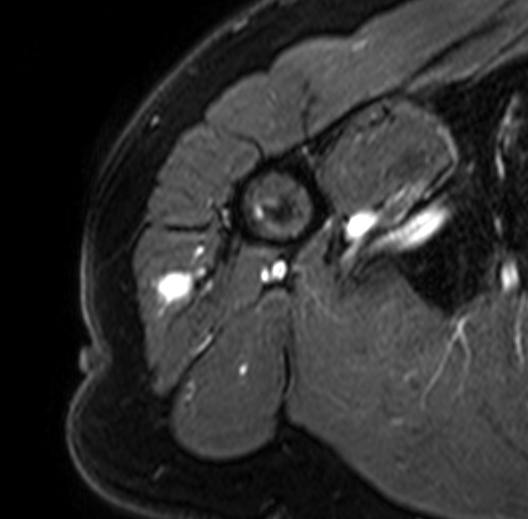 Glomus Tumor