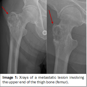 Metastatic Image 1