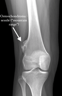 Osteochrondroma Image 1