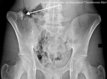 Osteochrondroma Image 2