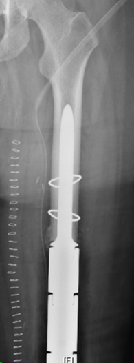 Osteosarcoma Image 2