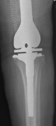Osteochrondroma Image 3