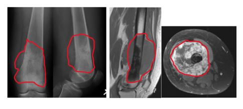 Osteosarcoma Image