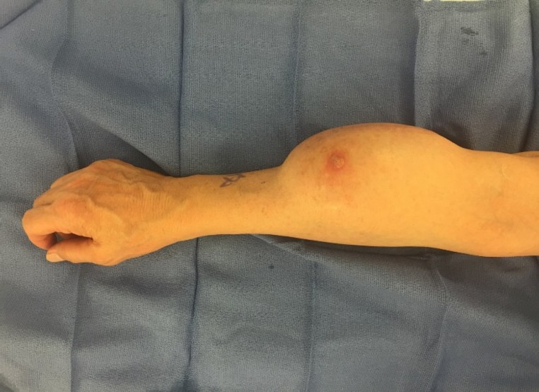 Sarcoma Image 1