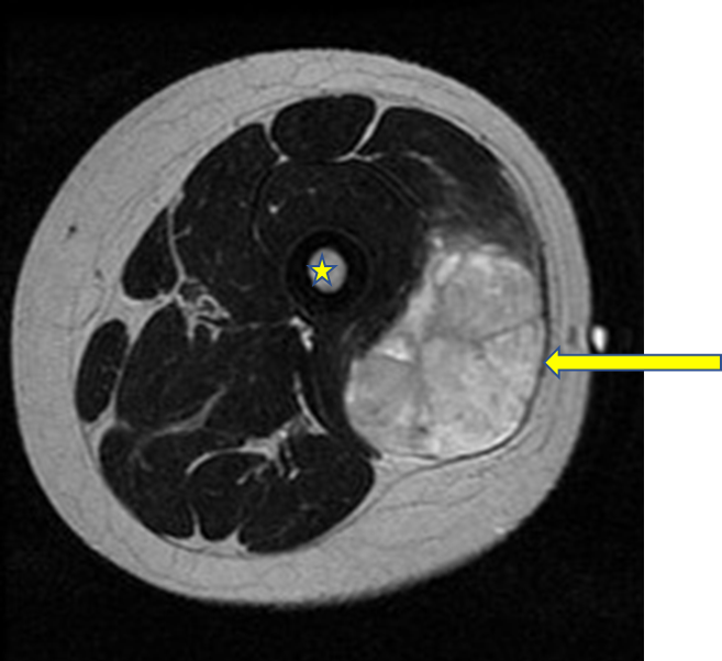 Sarcoma Image 2